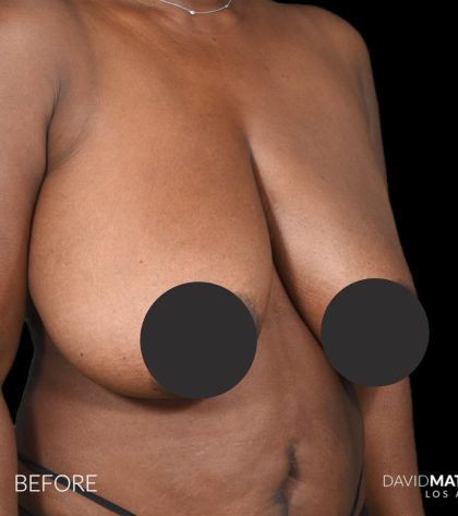 Breast Lift Before & After Patient #2763