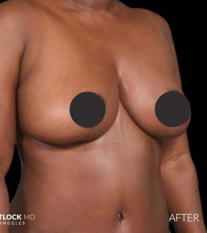 Breast Lift Before & After Patient #2763