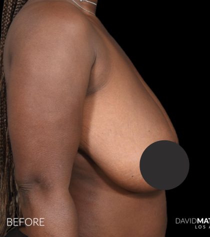 Breast Lift Before & After Patient #2763