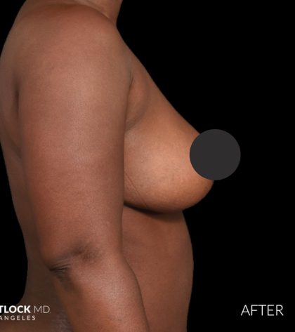 Breast Lift Before & After Patient #2763