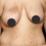 Breast Lift Before & After Patient #2764