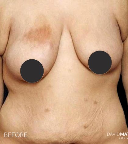 Breast Lift Before & After Patient #2764