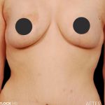 Breast Lift Before & After Patient #2764