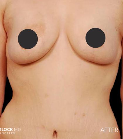Breast Lift Before & After Patient #2764