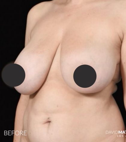 Breast Lift Before & After Patient #2765