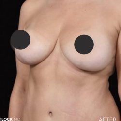 Breast Lift Before & After Patient #2765