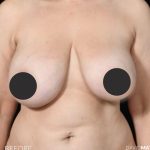 Breast Lift Before & After Patient #2765