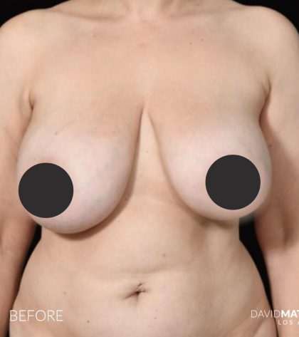 Breast Lift Before & After Patient #2765