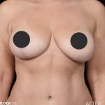 Breast Lift Before & After Patient #2765