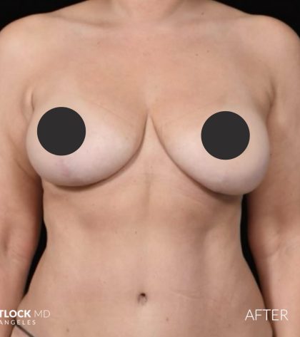 Breast Lift Before & After Patient #2765