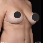 Breast Lift Before & After Patient #2765