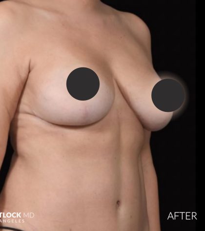 Breast Lift Before & After Patient #2765