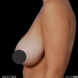 Breast Lift Before & After Patient #2766