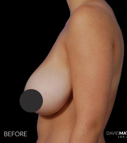 Breast Lift Before & After Patient #2766