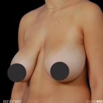 Breast Lift Before & After Patient #2766