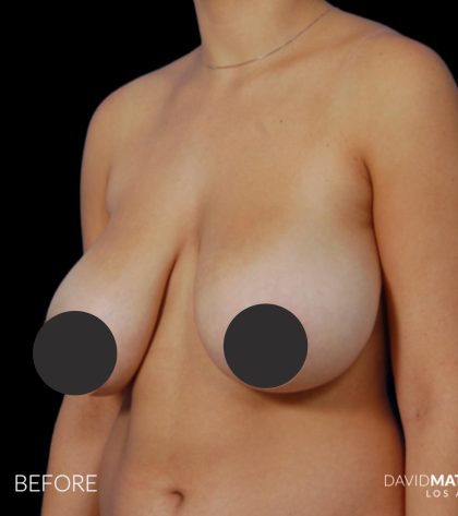 Breast Lift Before & After Patient #2766