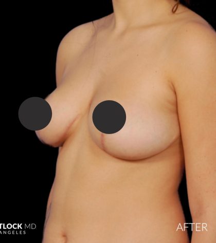 Breast Lift Before & After Patient #2766