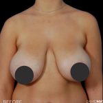 Breast Lift Before & After Patient #2766