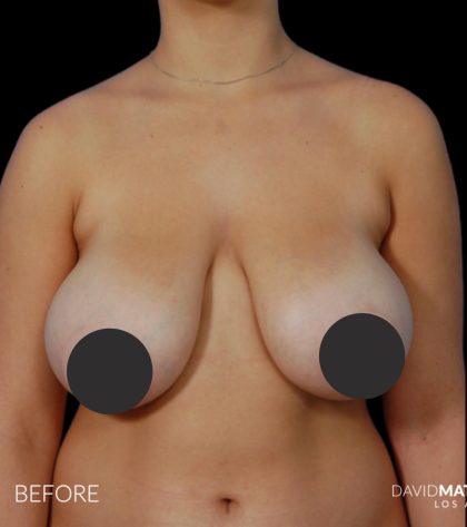 Breast Lift Before & After Patient #2766