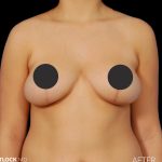 Breast Lift Before & After Patient #2766