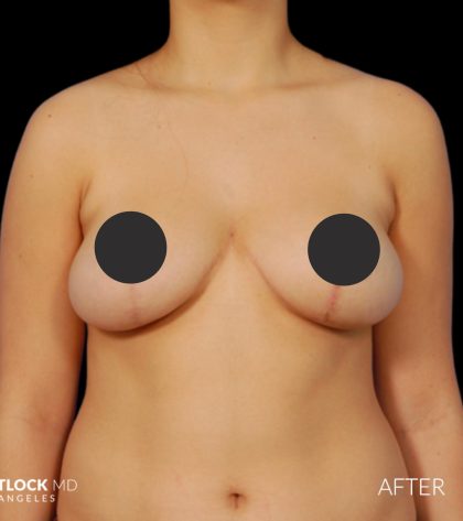 Breast Lift Before & After Patient #2766
