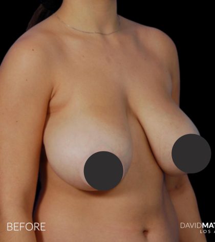 Breast Lift Before & After Patient #2766