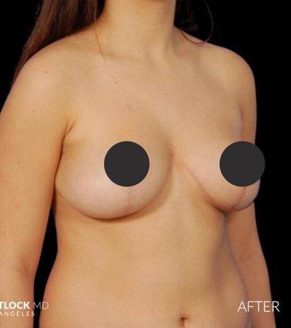 Breast Lift Before & After Patient #2766