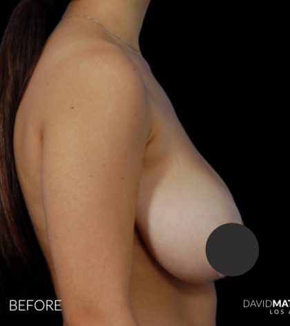 Breast Lift Before & After Patient #2766