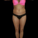 High Def Liposuction Female Before & After Patient #2713