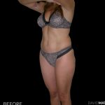 High Def Liposuction Female Before & After Patient #2704