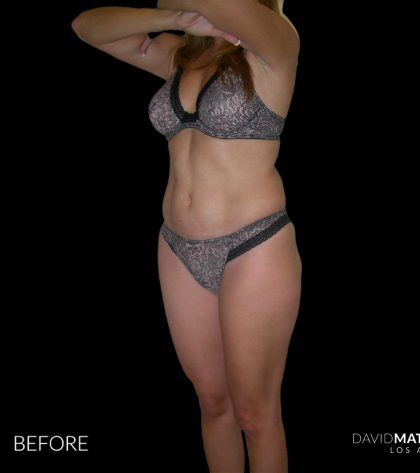 High Def Liposuction Female Before & After Patient #2704