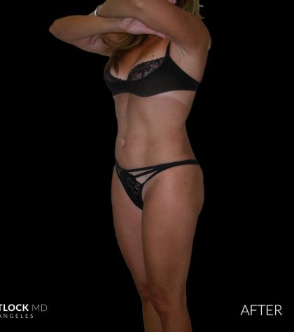 High Def Liposuction Female Before & After Patient #2704