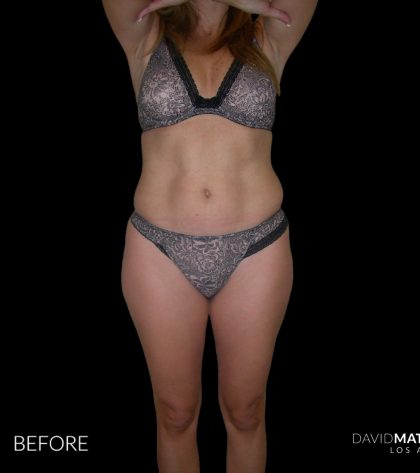 High Def Liposuction Female Before & After Patient #2704