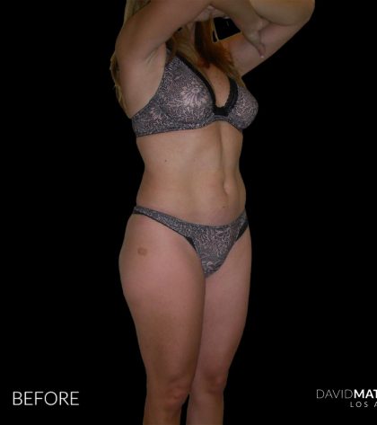 High Def Liposuction Female Before & After Patient #2704
