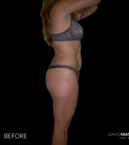 High Def Liposuction Female Before & After Patient #2704