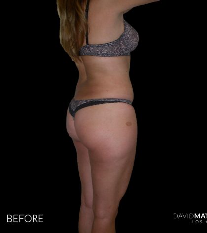High Def Liposuction Female Before & After Patient #2704