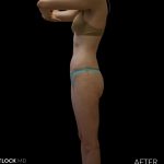 High Def Liposuction Female Before & After Patient #2705