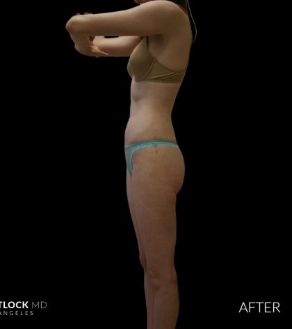 High Def Liposuction Female Before & After Patient #2705