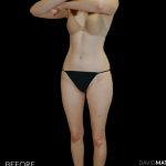 High Def Liposuction Female Before & After Patient #2705