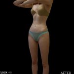 High Def Liposuction Female Before & After Patient #2705