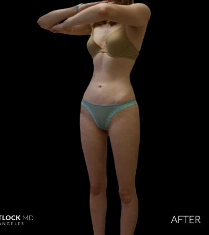 High Def Liposuction Female Before & After Patient #2705