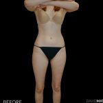 High Def Liposuction Female Before & After Patient #2705