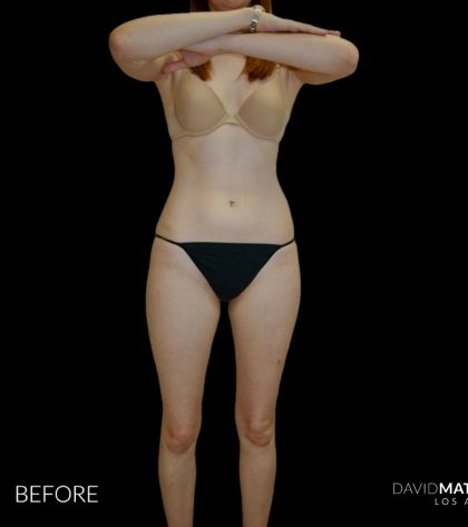 High Def Liposuction Female Before & After Patient #2705