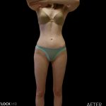 High Def Liposuction Female Before & After Patient #2705