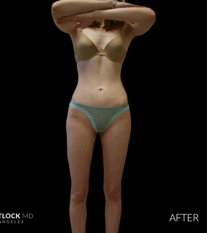 High Def Liposuction Female Before & After Patient #2705