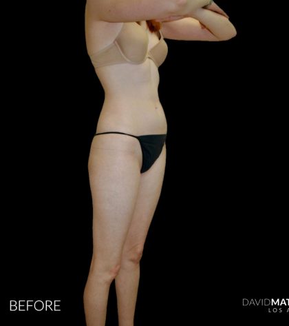 High Def Liposuction Female Before & After Patient #2705