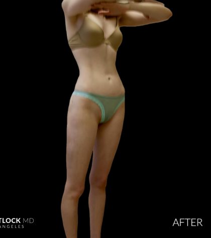 High Def Liposuction Female Before & After Patient #2705