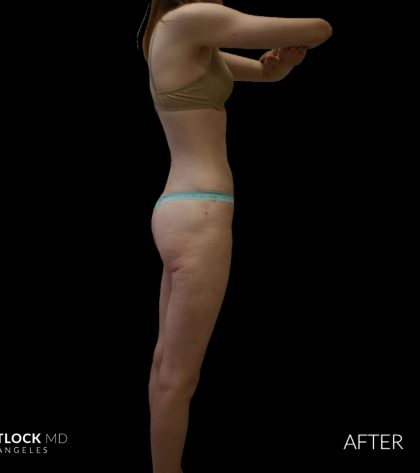 High Def Liposuction Female Before & After Patient #2705