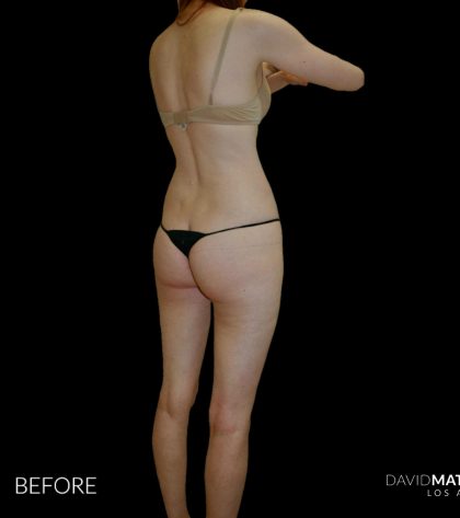 High Def Liposuction Female Before & After Patient #2705