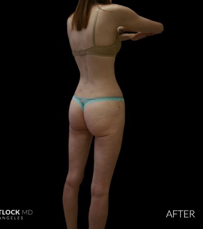 High Def Liposuction Female Before & After Patient #2705